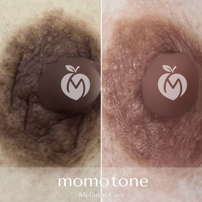 momotone 施術症例 ― 乳輪・乳首（乳輪｜40代女性・施術7回）のビフォーアフター