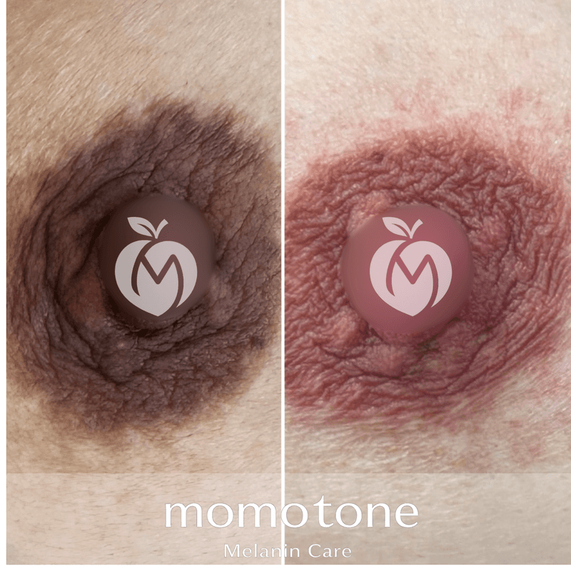 momotone 施術症例 ― 乳輪・乳首（乳首｜30代女性・施術6回）のビフォーアフター