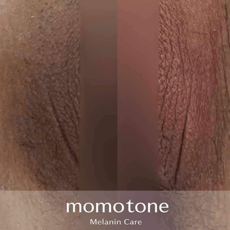 momotone 施術症例 ― 外陰部・股ぐら（30代女性・施術4回）のビフォーアフター
