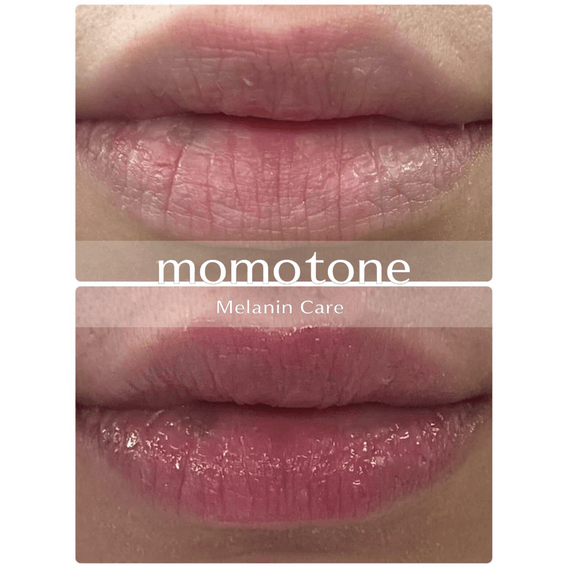 momotone 施術症例 ― 唇(20代女性・施術1回)のビフォーアフター
